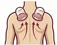 Cupping therapy applied to a patient's shoulder